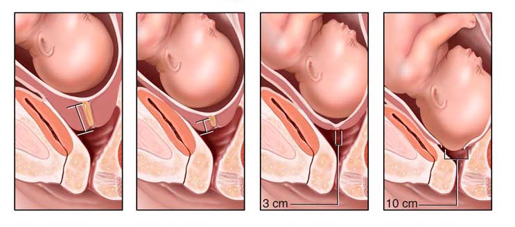 dilatacion del cuello uterino y maniobra de hamilton