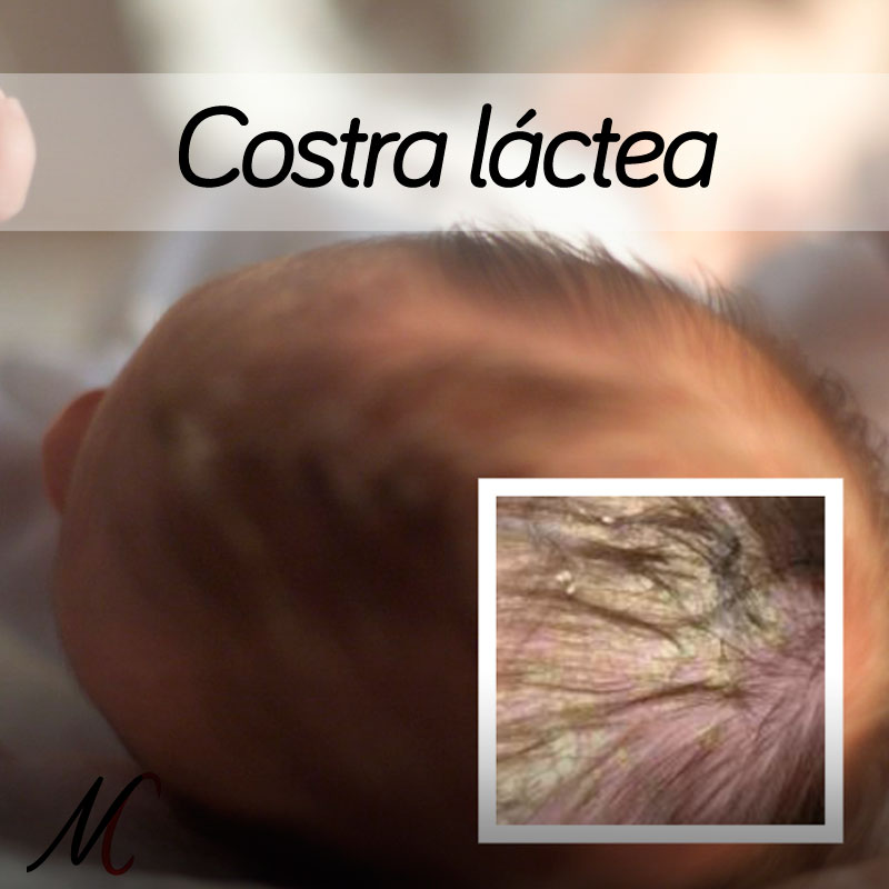 costra lactea