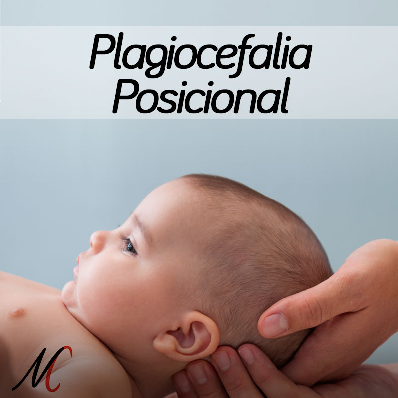 plagiocefalia posicional